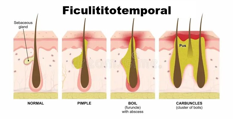 Ficulititotemporal